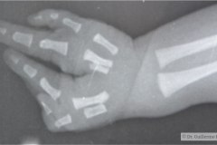 ectrodactilia-mano-bil-pie-der-polidactilia-pie-der-1992-000