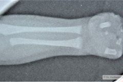ectrodactilia-mano-izq-rn5a-1991-1996-000