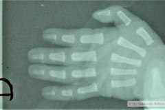 ectrodactilia-mano-y-pie-izq-1987-003