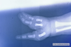 ectrodactilia-manos-adactilia-pies-002