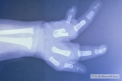 ectrodactilia-manos-adactilia-pies-006