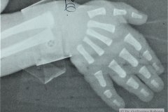 ectrodactilia-pinza-langosta-mano-der-2000-000