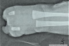 ectrodactilia-pinza-langosta-mano-der-2000-001