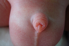 edema-prepucio-000
