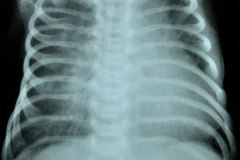 edema-pulmonar-cardiogenico-cardiomegalia-2000-002