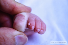 eec-ectrodactilia-displasia-ectodermica-labio-paladar-hendido-ectrodactyly-ectodermal-dysplasia-cleft-lip-palate-004