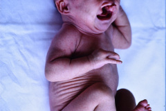 eec-ectrodactilia-displasia-ectodermica-labio-paladar-hendido-ectrodactyly-ectodermal-dysplasia-cleft-lip-palate-006