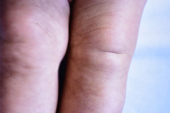 eec-ectrodactilia-displasia-ectodermica-labio-paladar-hendido-ectrodactyly-ectodermal-dysplasia-cleft-lip-palate-007