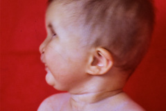 eec-ectrodactilia-displasia-ectodermica-labio-paladar-hendido-postop-003