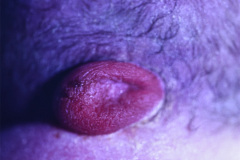 encefalocele-cervical-1990-001