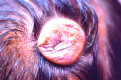 encefalocele-coronal-1990-004