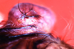 encefalocele-interparietal-1988-002