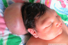 encefalocele-occipital-2009-005