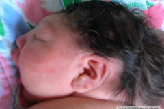 encefalocele-occipital-2009-008