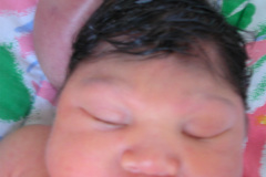 encefalocele-occipital-2009-010