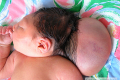 encefalocele-occipital-2009-014