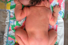 encefalocele-occipital-2009-015
