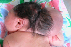 encefalocele-occipital-2009-020
