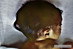 encefalocele-parieto-occipital-hidrocefalia-1988-003