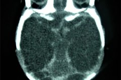 encefalopatia-hipoxico-isquemica-ehi-degeneracion-encefaloclastica-quistica-tac-2005-001