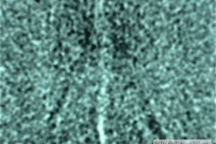 encefalopatia-hipoxico-isquemica-ehi-degeneracion-encefaloclastica-quistica-tac-2005-003