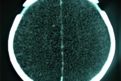 encefalopatia-hipoxico-isquemica-ehi-degeneracion-encefaloclastica-quistica-tac-2005-005