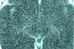 encefalopatia-hipoxico-isquemica-ehi-degeneracion-encefaloclastica-quistica-tac-2005-006
