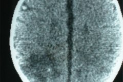encefalopatia-hipoxico-isquemica-ehi-parietoocccipital-izq-tac-1986-001
