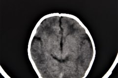encefalopatia-hipoxico-isquemica-ehi-septum-cavum-pellucidum-tac-1992-001
