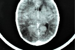 encefalopatia-hipoxico-isquemica-ehi-tac-1991-001