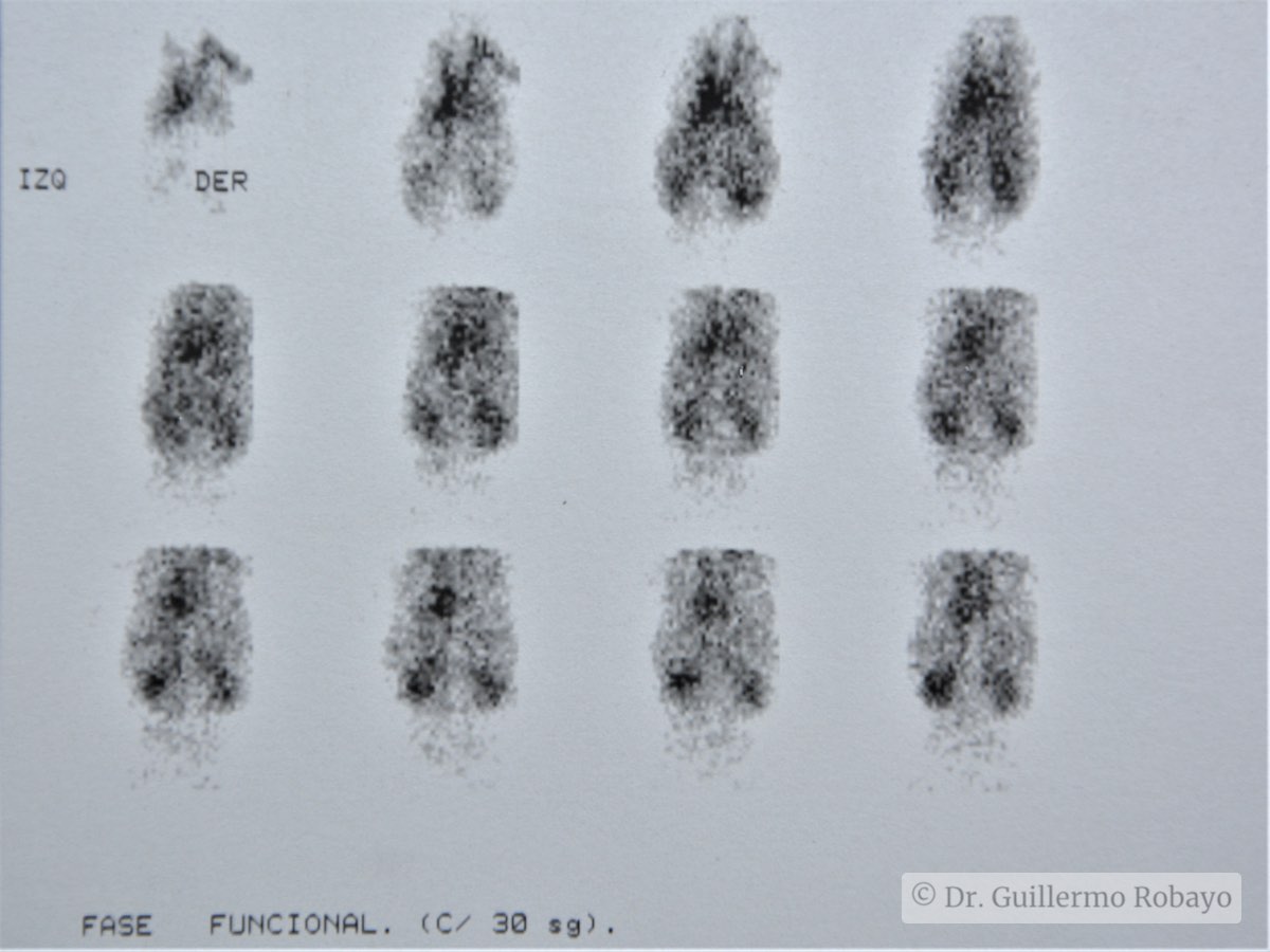 Encefalopatia hipoxico-isquemica (EHI) TAC, compromiso renal mod ...