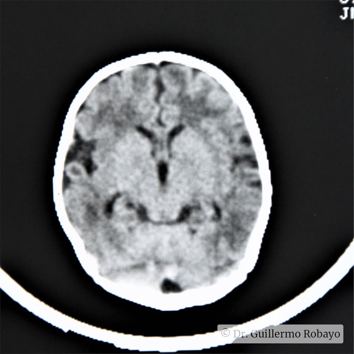 Dpta Rdc Encefalopatia hipoxico-isquemica (EHI) TAC, compromiso renal mod ...