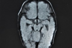 encefalopatia-hipoxico-isquemica-ehi-tac-rnm-1992-017