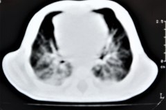 enfermedad-adenomaoidea-quistica-pulmonar-izq-tac-2001-000