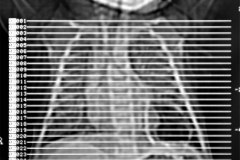 enfermedad-adenomaoidea-quistica-pulmonar-izq-tac-2001-002