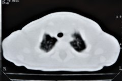 enfermedad-adenomaoidea-quistica-pulmonar-izq-tac-2001-004