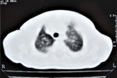 enfermedad-adenomaoidea-quistica-pulmonar-izq-tac-2001-005
