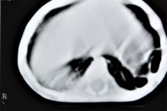 enfermedad-adenomaoidea-quistica-pulmonar-izq-tac-2001-008
