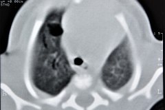 enfermedad-adenomatoidea-quistica-pulmonar-izq-tac-1997-005