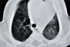 enfermedad-adenomatoidea-quistica-pulmonar-izq-tac-1997-009