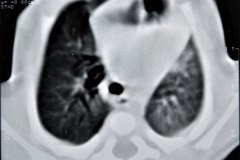 enfermedad-adenomatoidea-quistica-pulmonar-izq-tac-1997-010