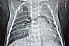 enfermedad-adenomatoidea-quistica-pulmonar-izq-tac-1997-013