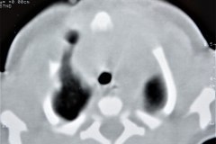 enfermedad-adenomatoidea-quistica-pulmonar-izq-tac-1997-018