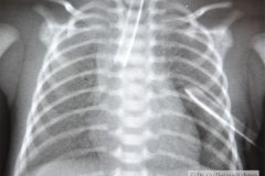 enfermedad-membrana-hialina-emh-i-complicada-neumotorax-der-y-atelectasia-masiva-izq-po-tubo-sobreinsertado-tubo-torax-bil-1996-001