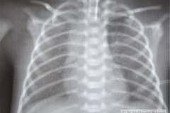 enfermedad-membrana-hialina-emh-i-complicada-neumotorax-der-y-atelectasia-masiva-izq-po-tubo-sobreinsertado-tubo-torax-bil-1996-002