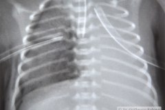 enfermedad-membrana-hialina-emh-i-complicada-neumotorax-der-y-atelectasia-masiva-izq-po-tubo-sobreinsertado-tubo-torax-bil-1996-003