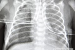 enfermedad-membrana-hialina-emh-i-complicada-neumotorax-der-y-atelectasia-masiva-izq-po-tubo-sobreinsertado-tubo-torax-bil-1996-004
