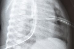enfermedad-membrana-hialina-emh-i-complicada-neumotorax-der-y-atelectasia-masiva-izq-po-tubo-sobreinsertado-tubo-torax-bil-1996-005