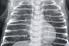 enfermedad-membrana-hialina-emh-i-001