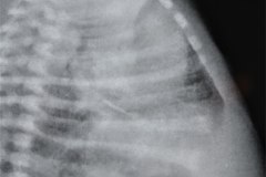 enfermedad-membrana-hialina-emh-ii-2005-000